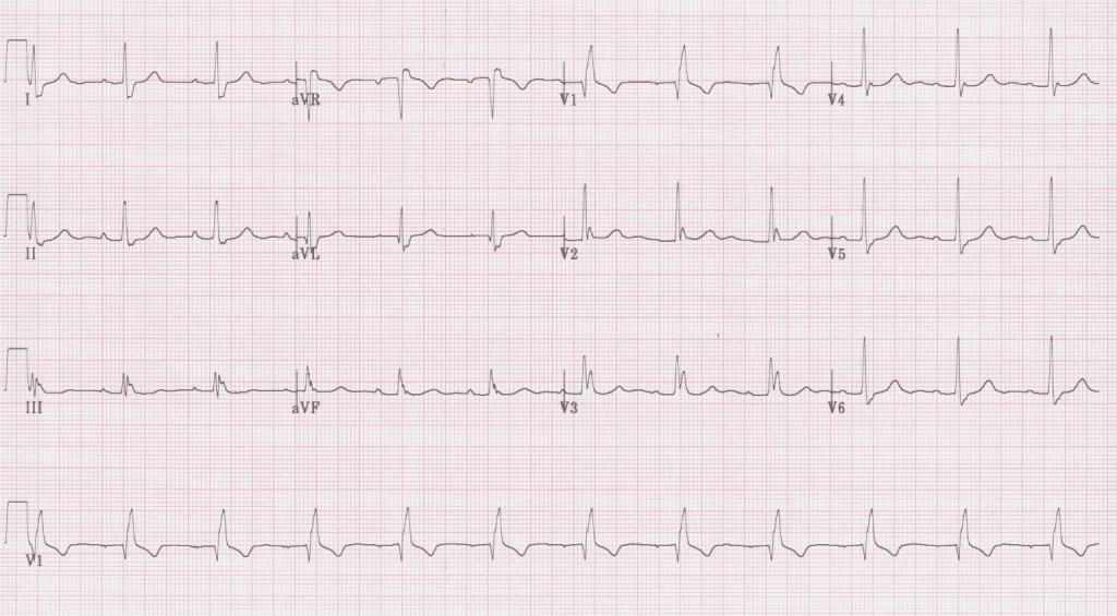 EKG Examples | Torrey EKG