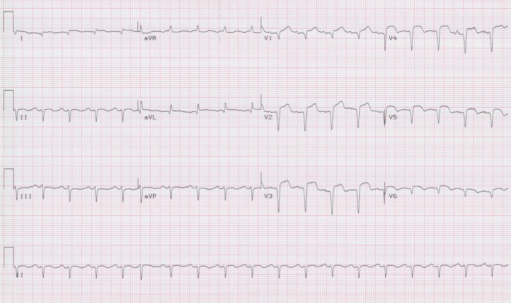 EKG Examples | Torrey EKG